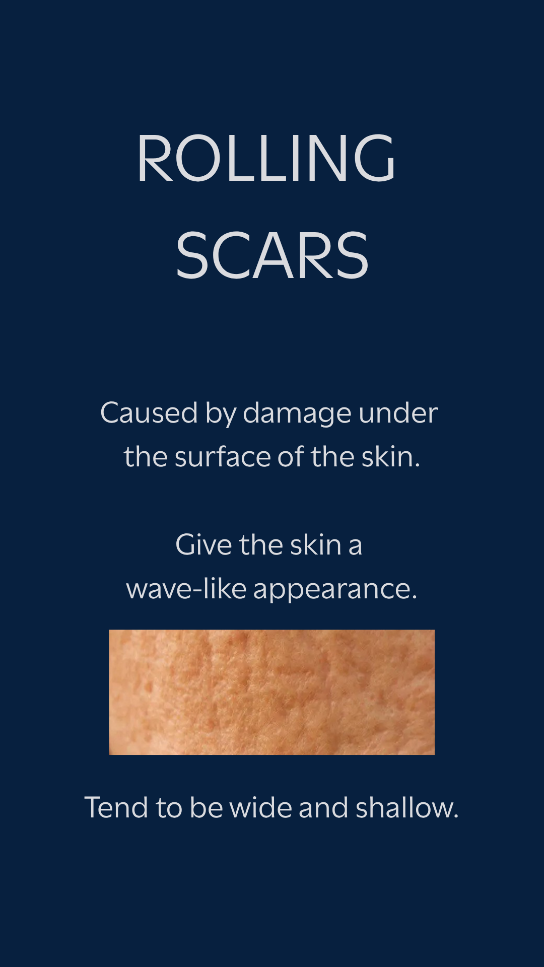 Rolling acne scars — wide, shallow, wave-like appearance