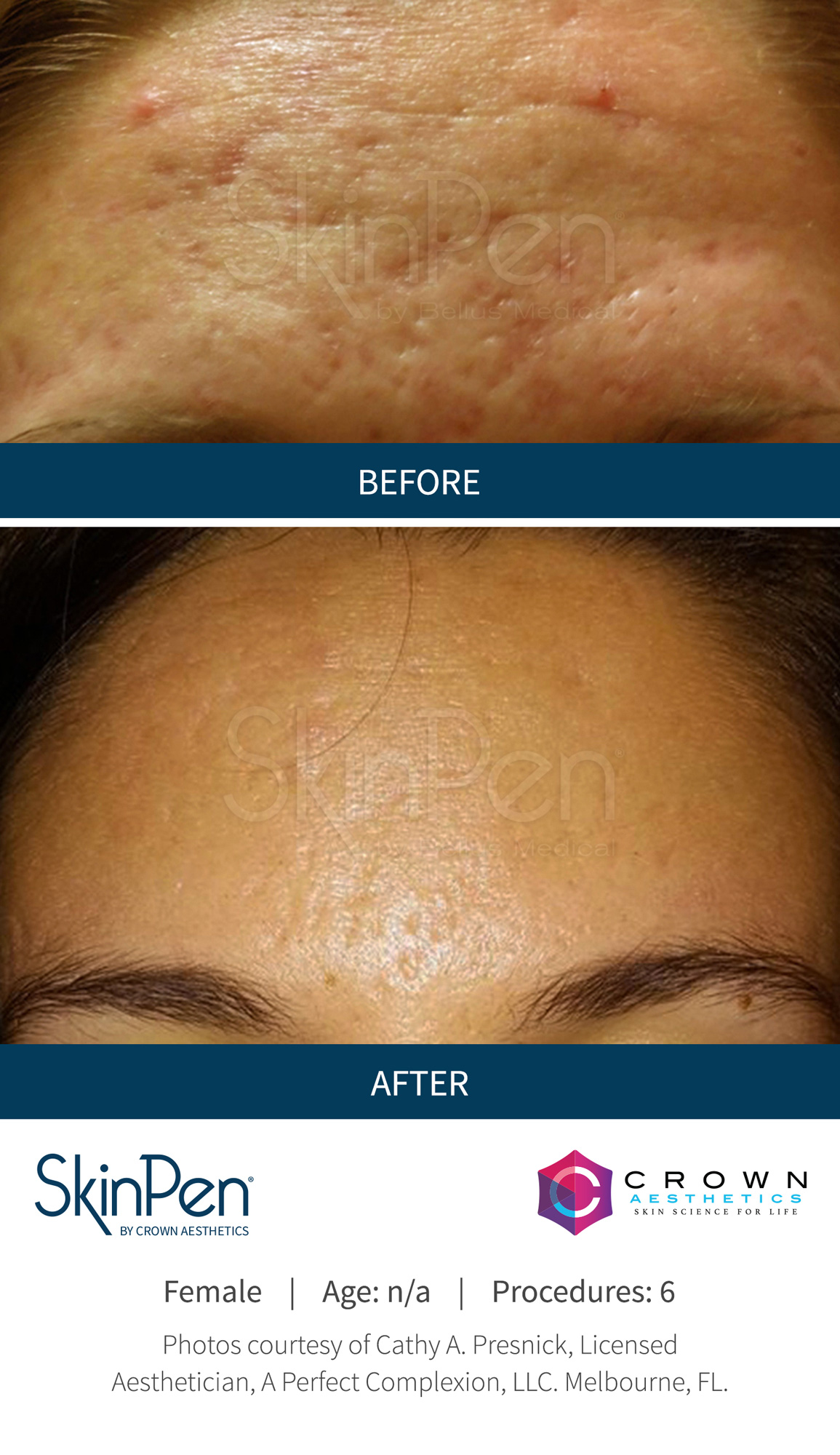 SkinPen before and after — forehead acne scarring after 6 sessions