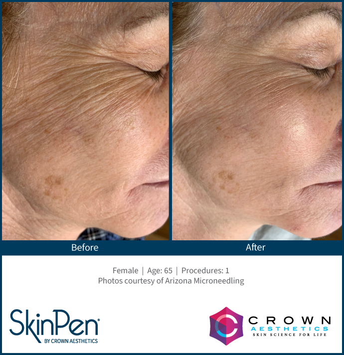 SkinPen before and after — fine lines and wrinkles after 1 treatment