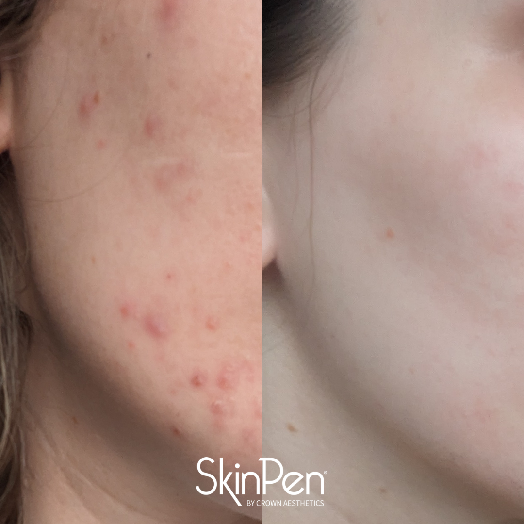 Your First SkinPen Microneedling Treatment: What Actually Happens, Step by Step