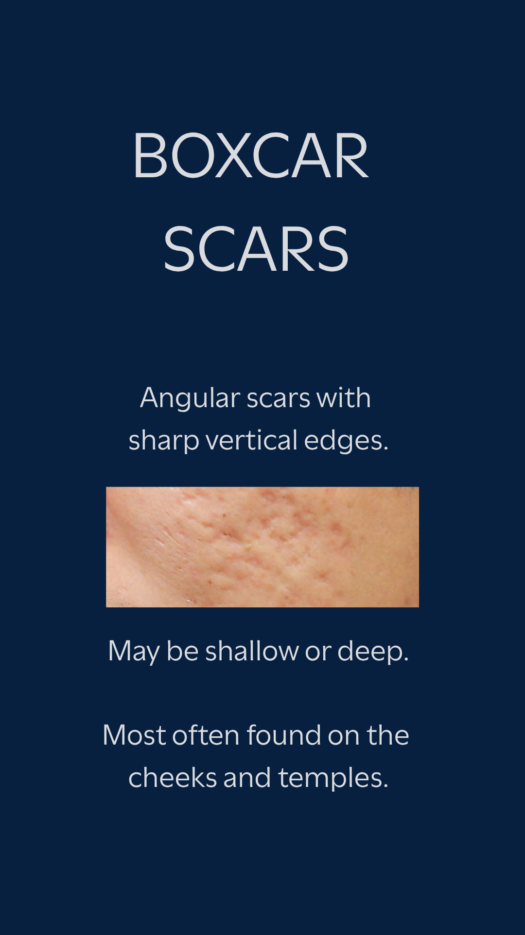 Boxcar acne scars — angular with sharp vertical edges