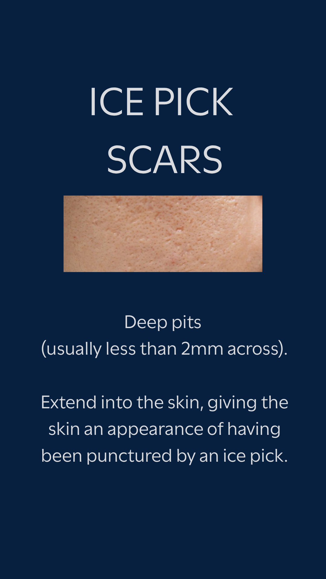 Ice pick acne scars — deep, narrow pits