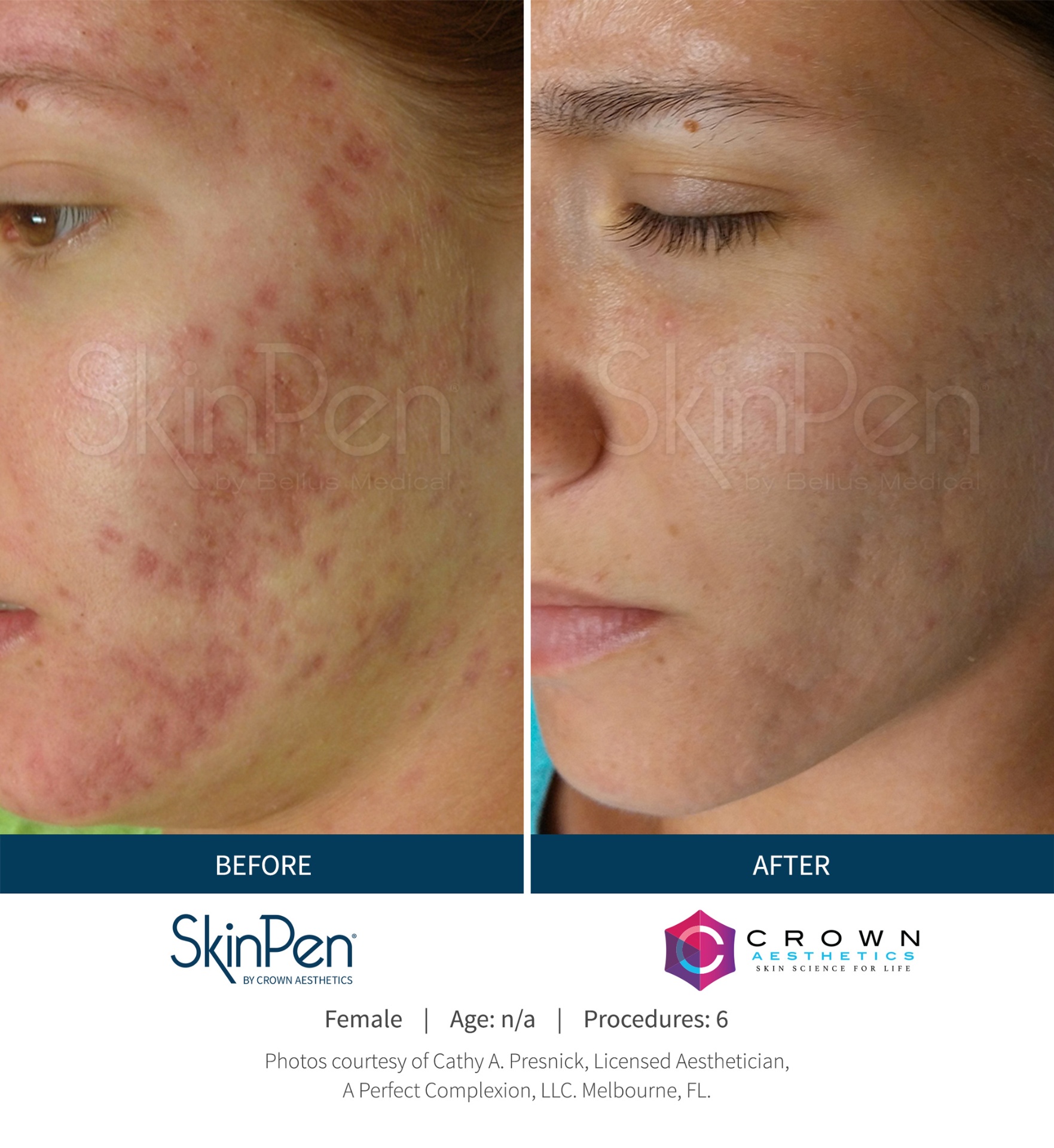 Before and after 6 SkinPen microneedling sessions — active acne and texture