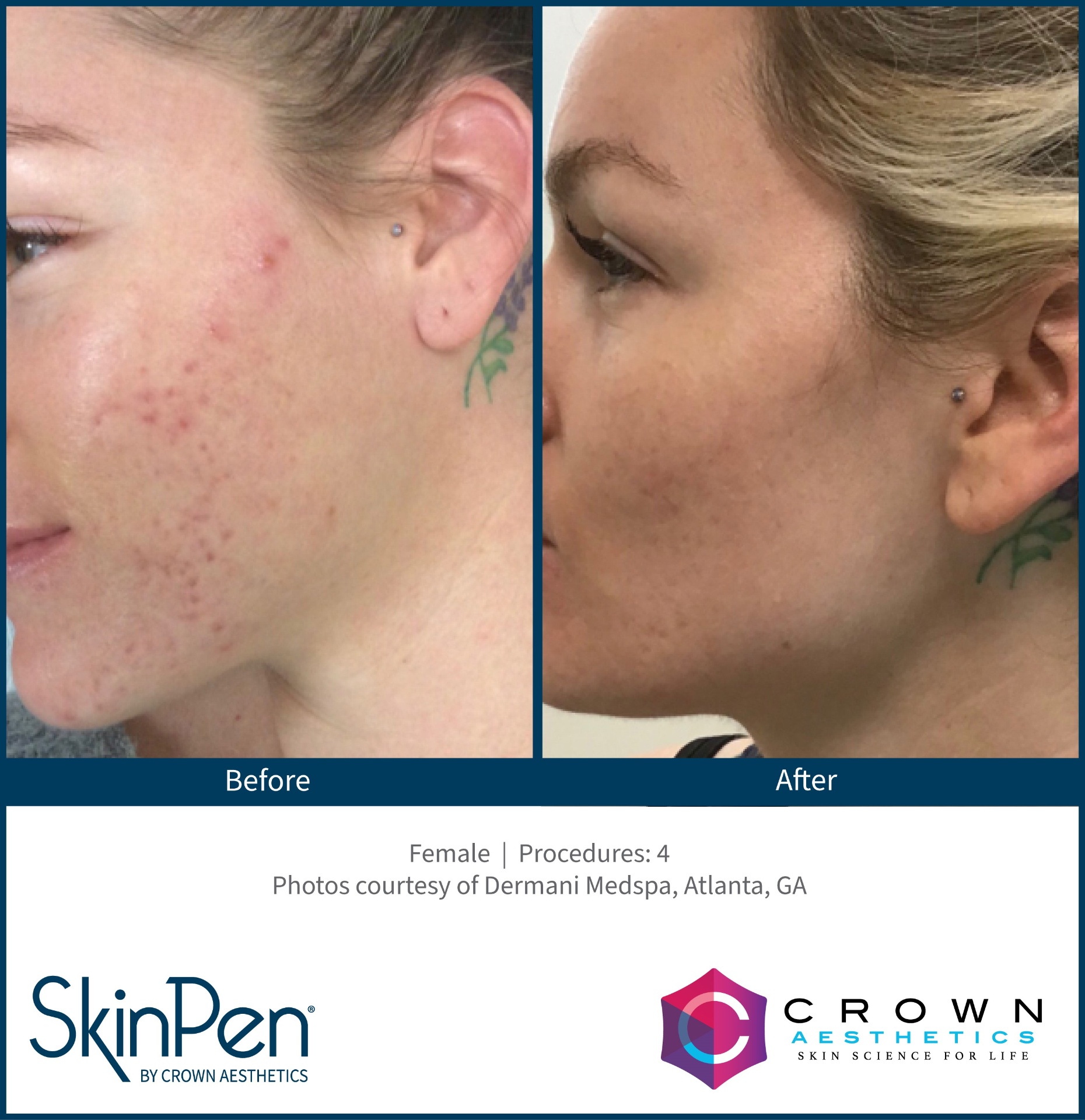 Before and after 4 SkinPen microneedling sessions — acne scarring