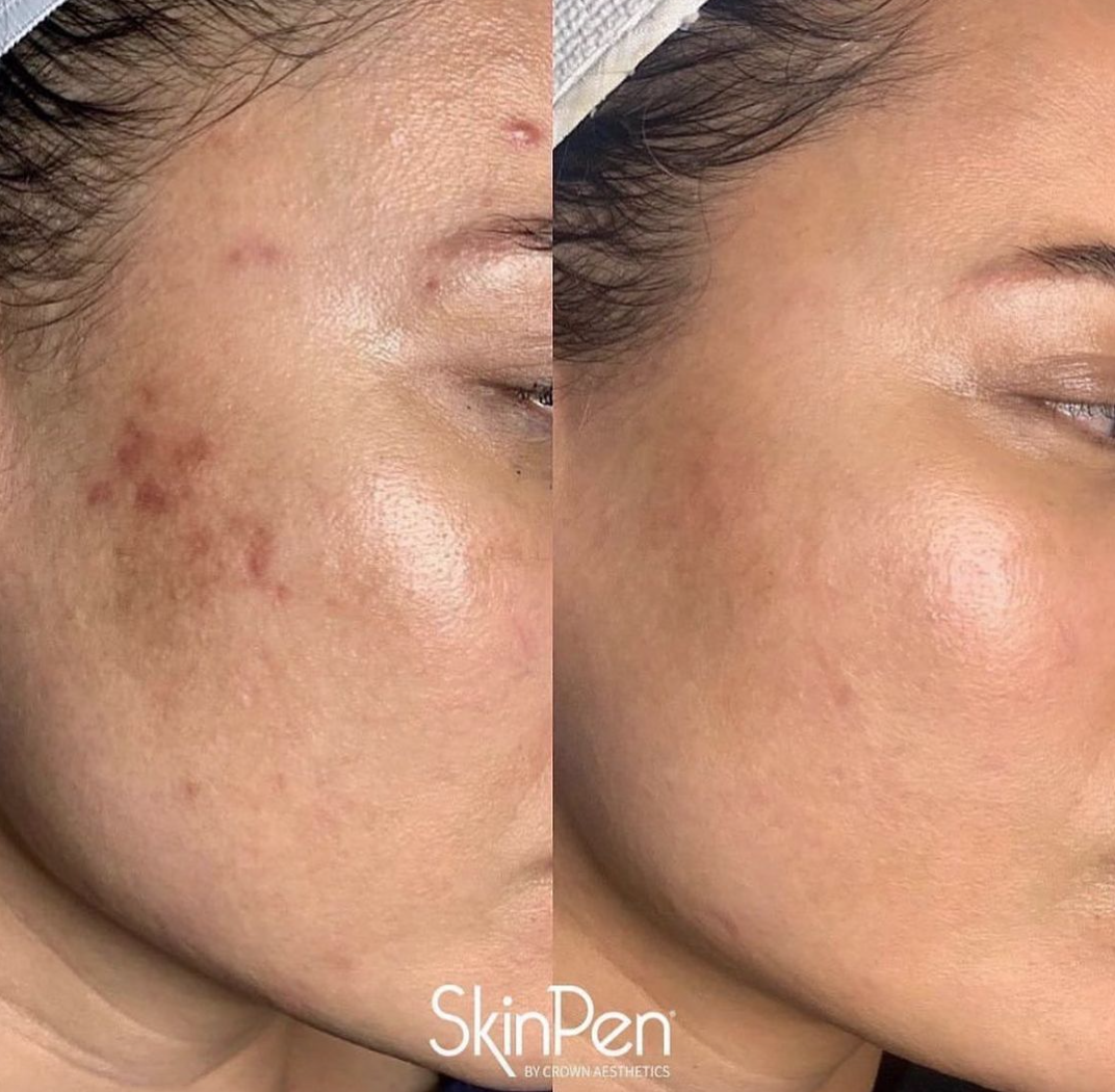 SkinPen microneedling before and after on acne scarring